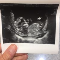 Abdominal 13 semanas