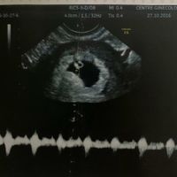 Ayuda con método ramzi: niño o niña? - 1