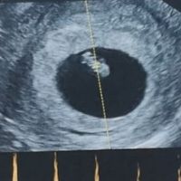 Ayuda con método ramzi: niño o niña? - 1