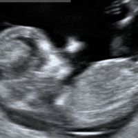 Ayuda con método ramzi: niño o niña? - 1