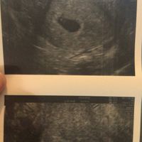 Ayuda con método ramzi: niño o niña? - 1