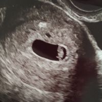 Ayuda con método ramzi: niño o niña? - 1