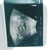 Ayuda con método ramzi: niño o niña? - 3