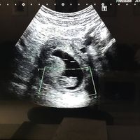Ayuda con método ramzi: niño o niña? - 1