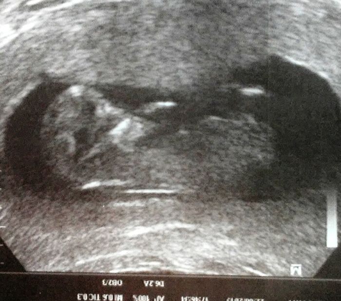 Tubérculo genital: niña - 1
