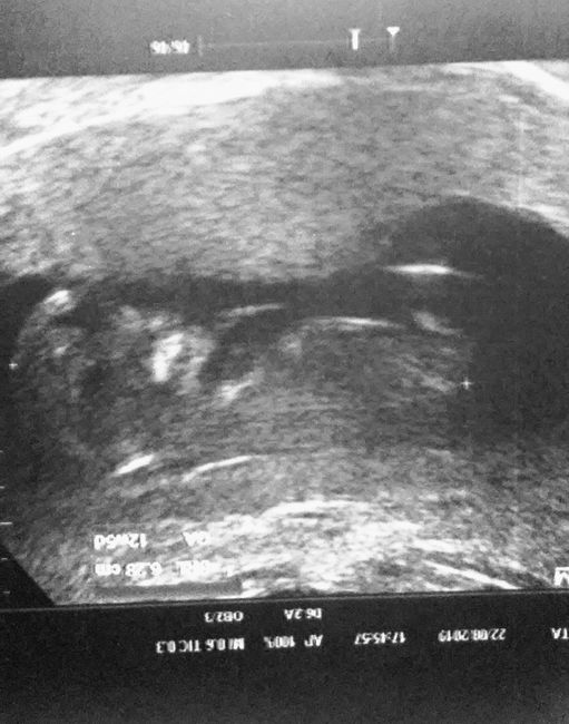 Tubérculo genital: niña - 2