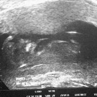 Tubérculo genital: niña - 2