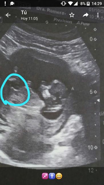 Tubérculo genital: niña - 1