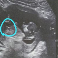 Tubérculo genital: niña - 1