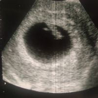 Ayuda con método ramzi: niño o niña? - 1