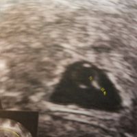 Ayuda con método ramzi: niño o niña? - 1
