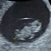 Ayuda con método ramzi: niño o niña? - 1