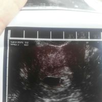 Ayuda con método ramzi: niño o niña? - 1