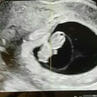 Ayuda con método ramzi: niño o niña? - 1
