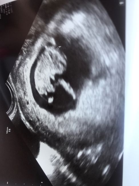 Ayuda con el sexo del bebe 1
