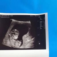 Ayuda con método ramzi: niño o niña? - 1