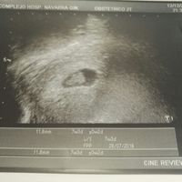 Ayuda con método ramzi: niño o niña? - 1
