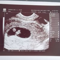 Ayuda con método ramzi: niño o niña? - 1