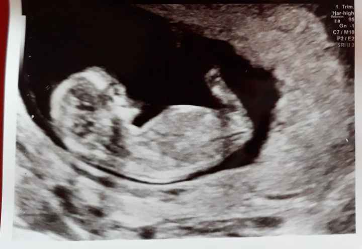 Ayuda con método ramzi: niño o niña? 10