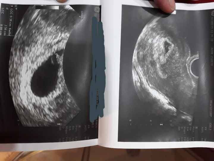 Ayuda con método ramzi: niño o niña? 11
