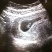Ecografia de 7+3 semanas