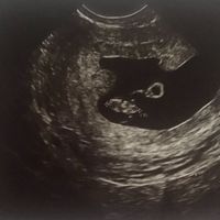 Ayuda con método ramzi: niño o niña? - 1