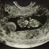 Ayuda con método ramzi: niño o niña? - 3