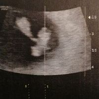 Ayuda con método ramzi: niño o niña? - 1