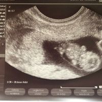 Ayuda con método ramzi: niño o niña? - 1