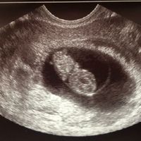 Ayuda con método ramzi: niño o niña? - 2