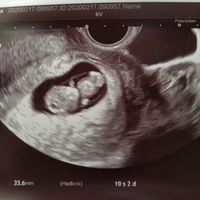 Ayuda con método ramzi: niño o niña? - 1