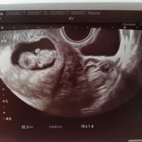 Ayuda con método ramzi: niño o niña? - 2