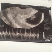 Ayuda con método ramzi: niño o niña? - 1