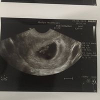 Ayuda con método ramzi: niño o niña? - 1