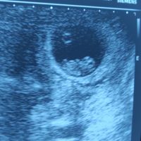 Ayuda con método ramzi: niño o niña? - 1