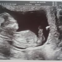 Ayuda con método ramzi: niño o niña? - 1