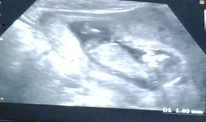 Tubérculo genital niño o niña??? - 1