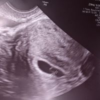 Ayuda con método ramzi: niño o niña? - 1