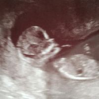 Tubérculo genital: niña - 1