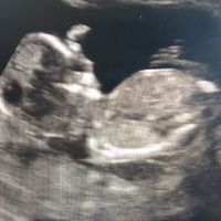 Ayuda con método ramzi: niño o niña? - 1