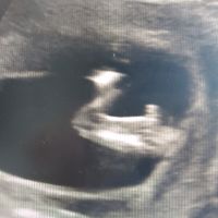 Ayuda con método ramzi: niño o niña? - 2