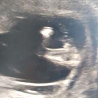 Ayuda con método ramzi: niño o niña? - 3