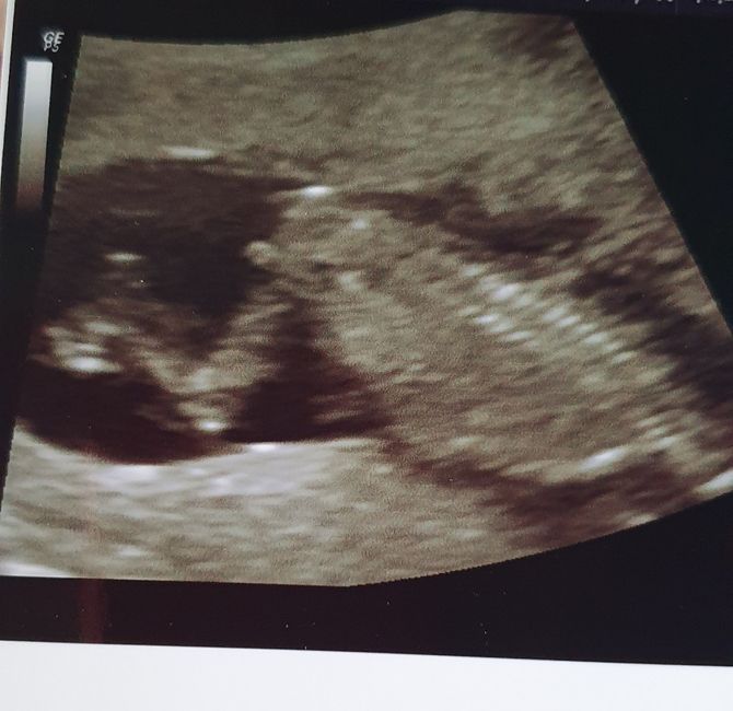 Tubérculo genital: niña - 1