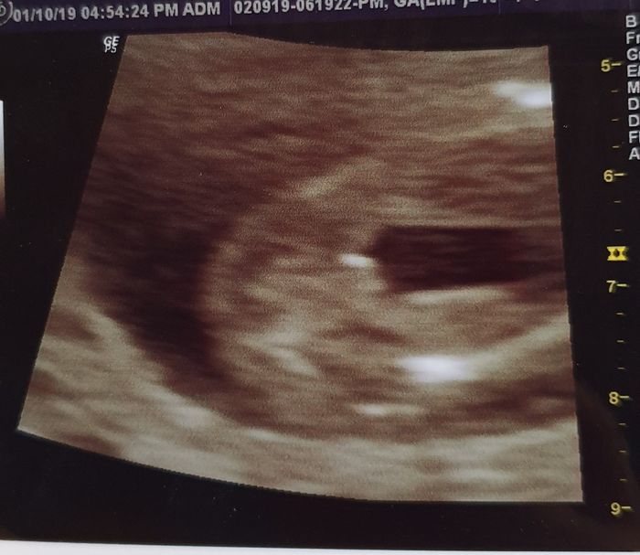 Tubérculo genital: niña - 1