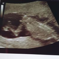 Tubérculo genital: niña - 1