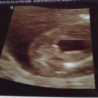 Tubérculo genital: niña - 1