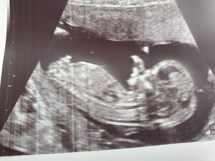 Tubérculo genital niño o niña??? - 1