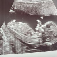 Tubérculo genital niño o niña??? - 1