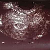 Ayuda con método ramzi: niño o niña? - 1