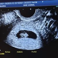 Ayuda con método ramzi: niño o niña? - 1
